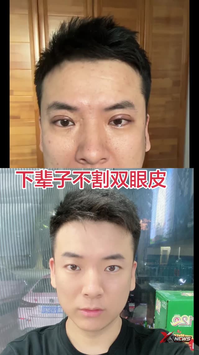 男人割双眼皮，你是我见到的第一位。